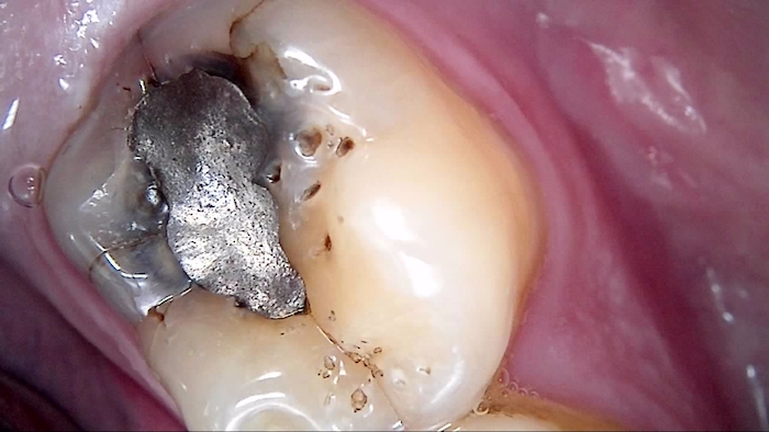 A close up of a silver filling in a tooth