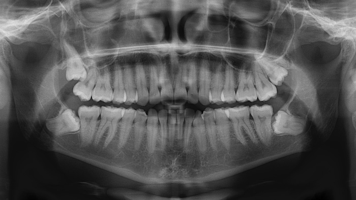 An x-ray of misaligned wisdom teeth