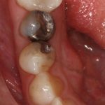 Bottom of a mouth with silver fillings