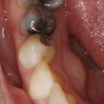 Bottom of a mouth with silver fillings