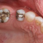 Roof of a mouth with silver fillings