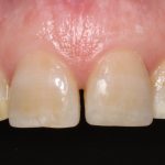 Discoloured and graying teeth