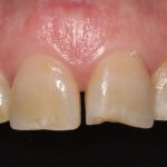 Discoloured and chipped teeth