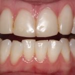 A close up of yellowing and slightly crooked teeth