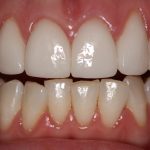 A close up of whitened teeth