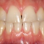 Discoloured and uneven teeth