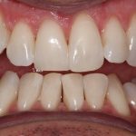 A close up of whitened teeth