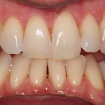 A close up of yellowing teeth
