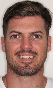 A young man smiling with asymmetrical teeth