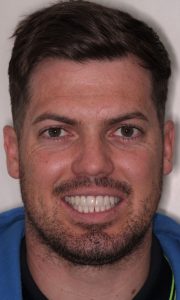 A young man smiling showing off his symmetrical teeth