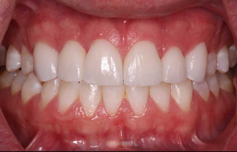 White symmetrical teeth