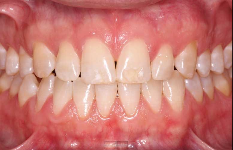 Discoloured teeth