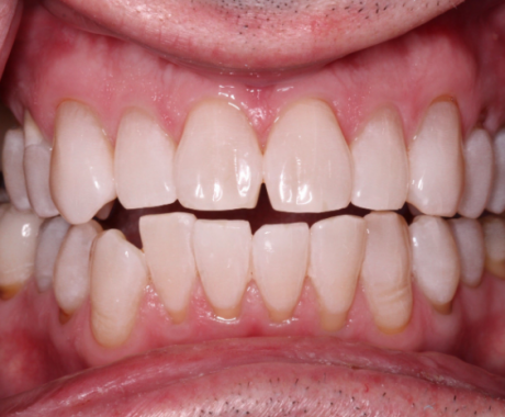 After picture of bright white teeth