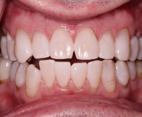 case-study-after After picture of bright white teeth