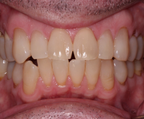 Before picture of yellowing teeth