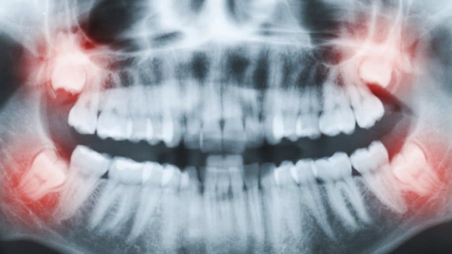 wisdom teeth X-ray