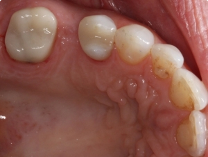 plain dental crowns