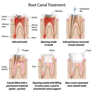 root canal therapy explained