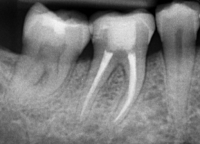 root-canal-treatment root canal treatment X-ray