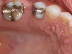 silver dental crowns