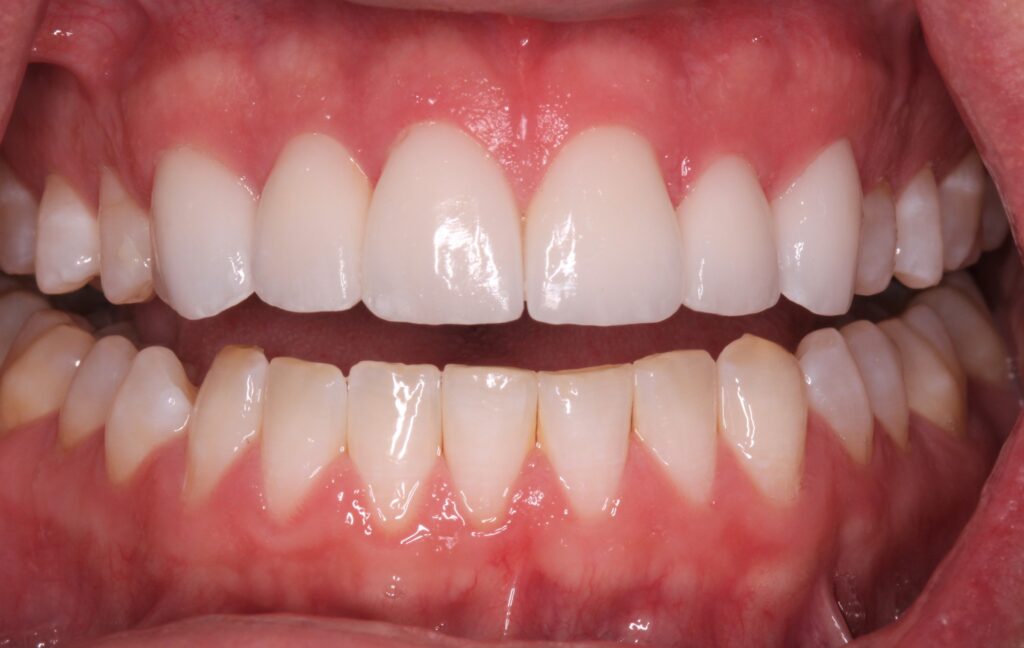 veneers resulting in well aligned teeth