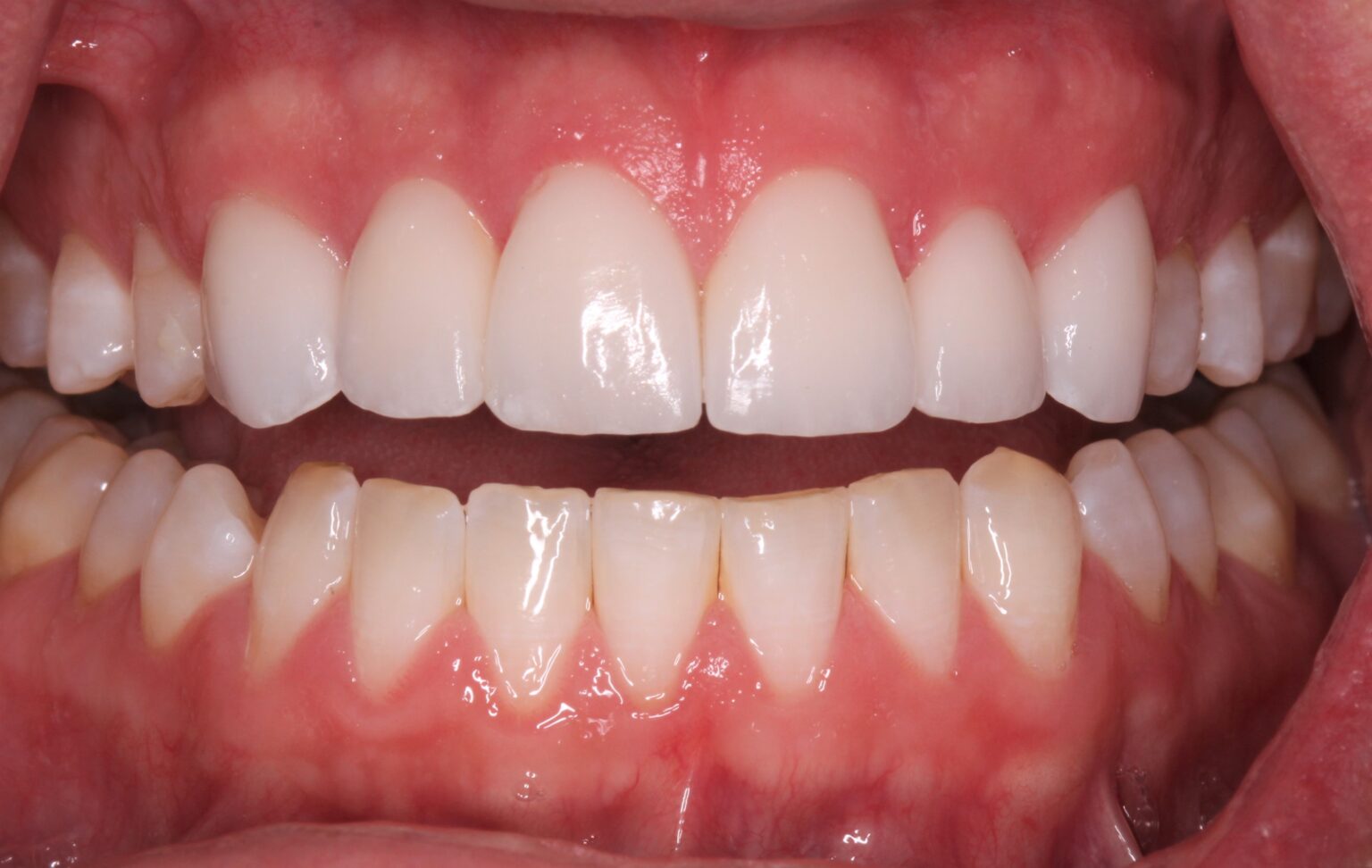 Dental Veneers North Sydney KB Village Dental