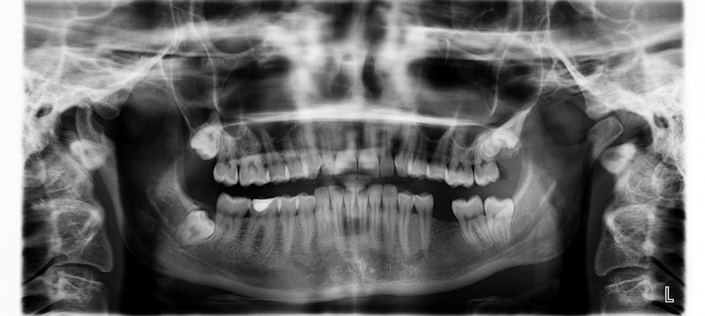 An xray of a mouth with a missing tooth