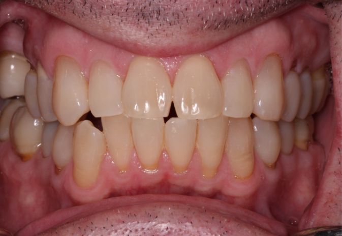 Close up of yellow teeth in mouth