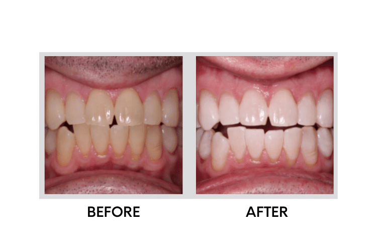 Teeth Whitening - 1
