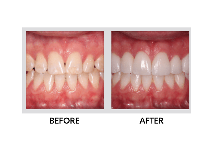 Teeth Whitening - 2