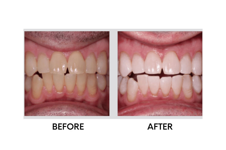Teeth Whitening - 3