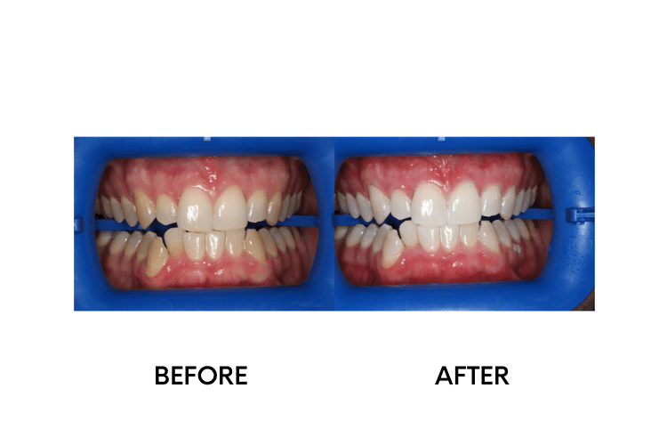 Teeth Whitening - 4