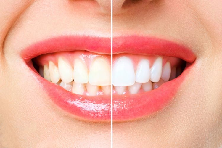 teeth changing colour