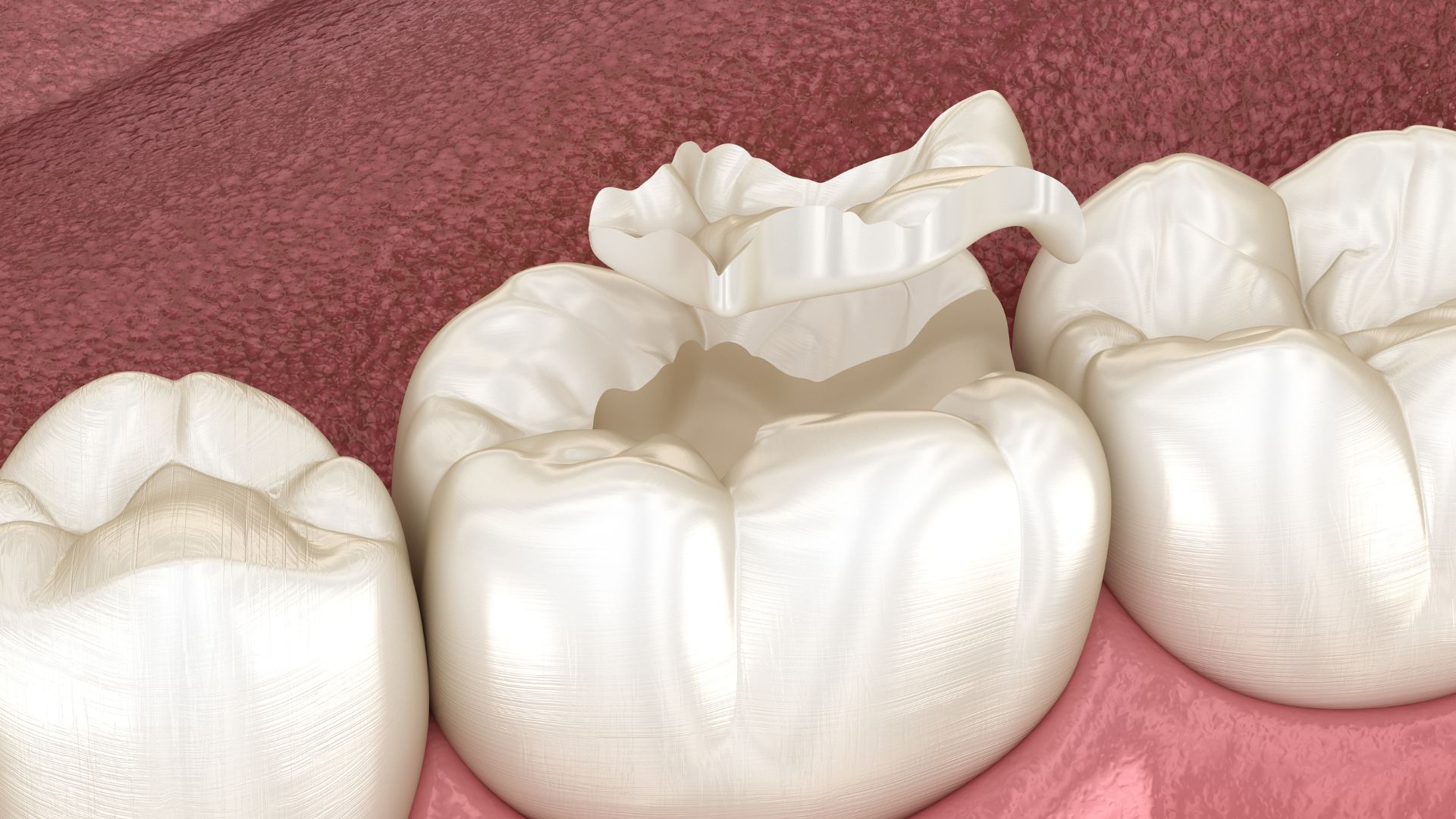 ceramic fillings on tooth