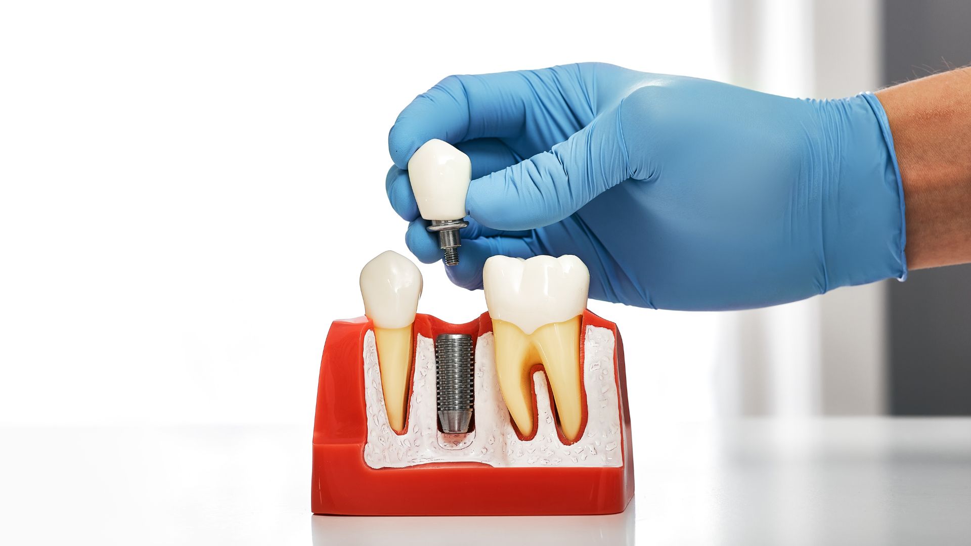 dental implants