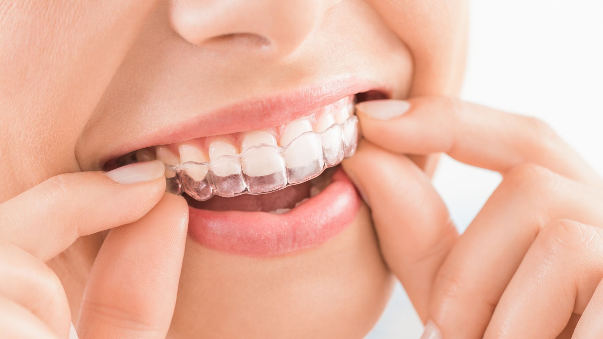 invisalign over veneers